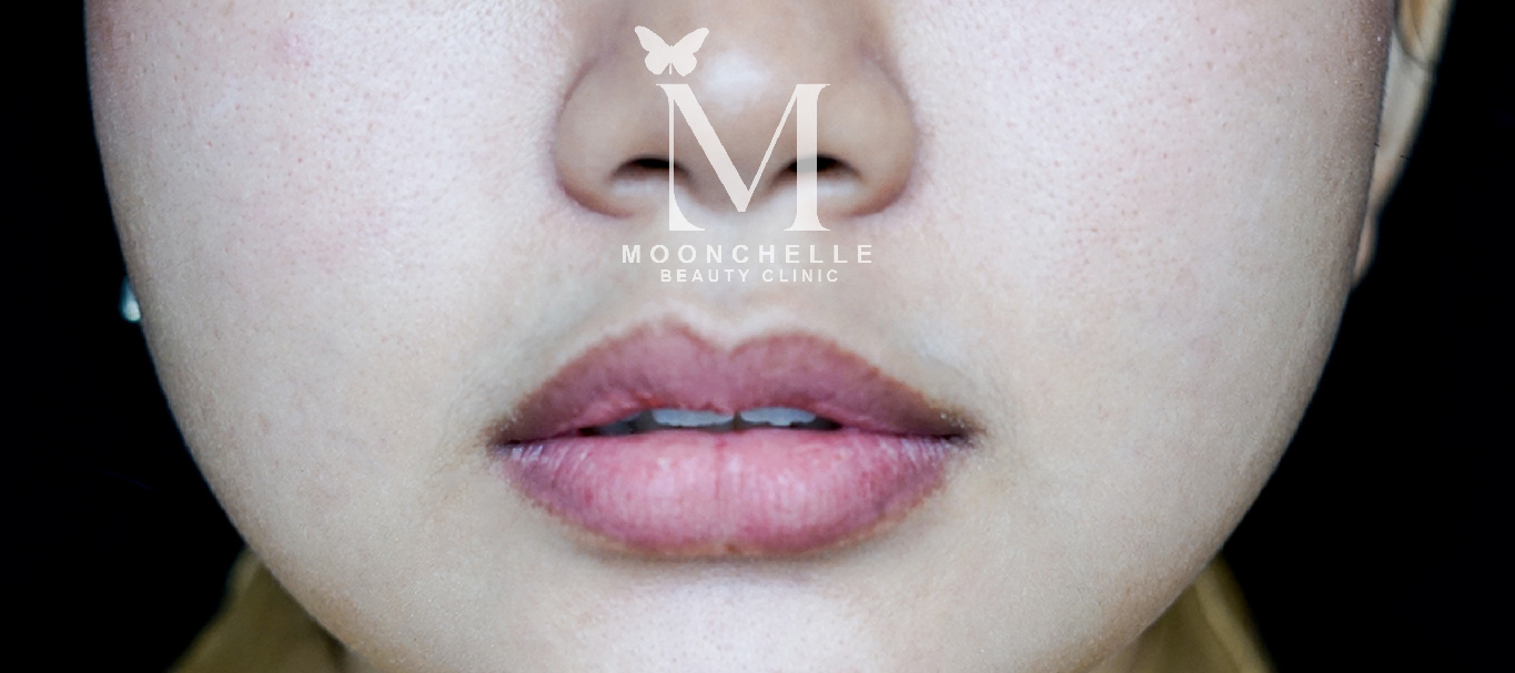 Photo Cherrylips Before