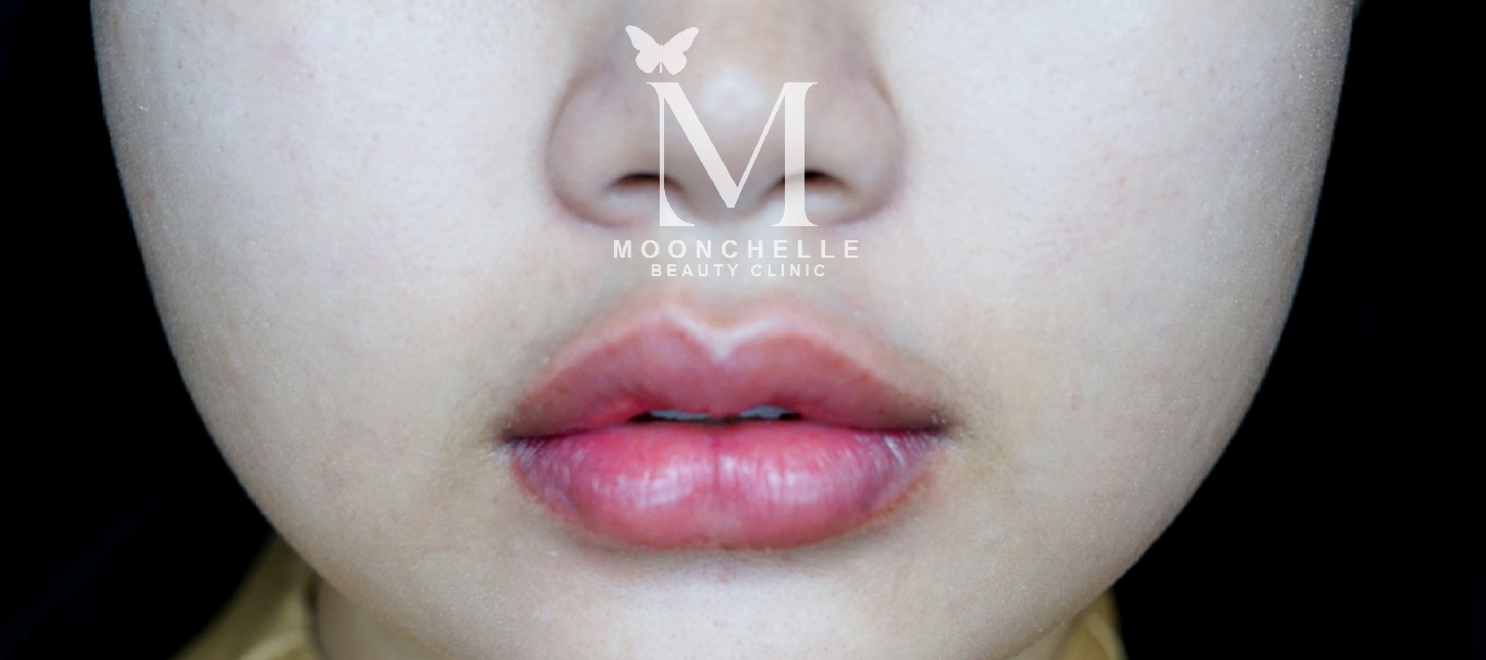 Photo Cherrylips After