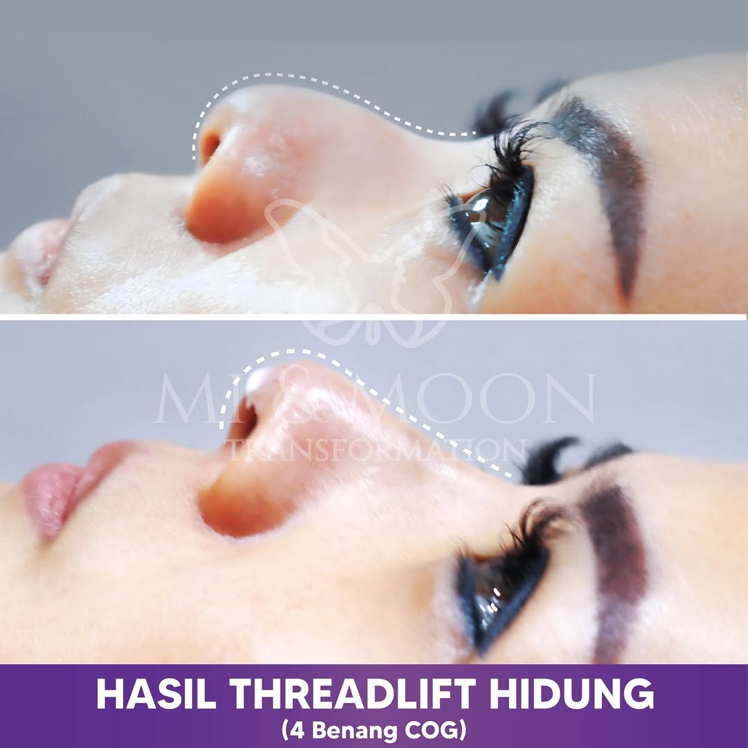 Klinik Kecantikan Surabaya Barat Moonchelle Beauty Clinic