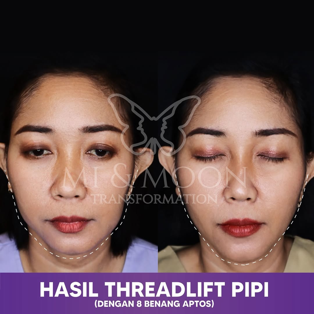 Klinik Kecantikan Surabaya Barat Moonchelle Beauty Clinic